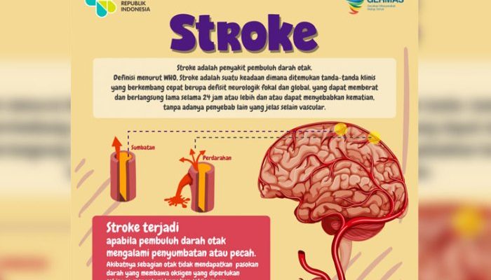 Tips Menurunkan Risiko Stroke Sejak Dini untuk Hidup Sehat