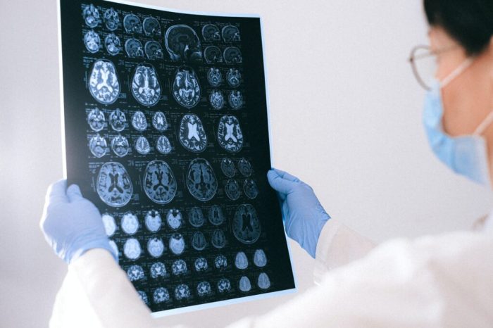 Ciri-Ciri Tumor Otak pada Anak, Termasuk Sering Pusing? | Halaman Lengkap Anak yang Didiagnosa Tumor Otak Jalani Kehidupan Normal