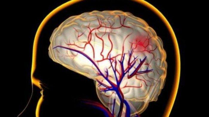 Gejala Tumor Otak:10 Simptom Yang Kita Semua Perlu Tahu! Dari Vonis Tumor Otak ke Kesembuhan, Ini Perjalanannya
