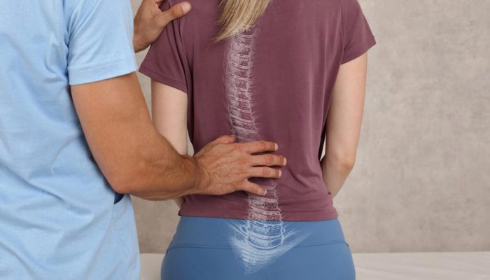 Skoliosis Jangan Dianggap Remeh, Ketahui Langkah Pencegahan dan Penanganan yang Tepat