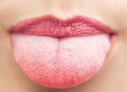 Lidah Putih Tanda Apa? Arti Warna, Penyebab dan Cara Mengatasinya