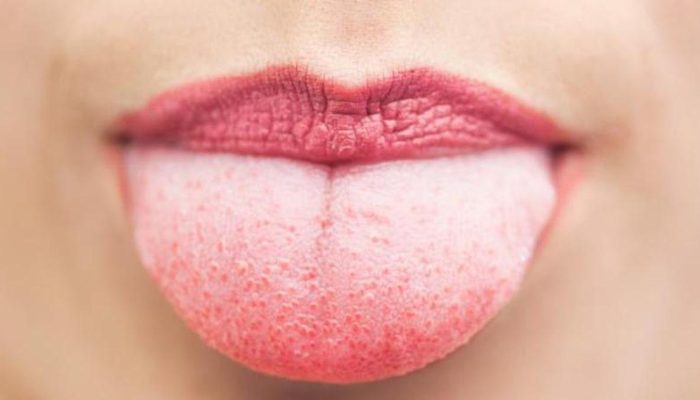 Lidah Putih Tanda Apa? Arti Warna, Penyebab dan Cara Mengatasinya