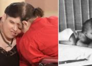 Kembar Siam Kondisi Langka Sejak Dalam Kandungan yang Perlu Diketahui