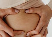 Pria Juga Dapat Mengalami Stretch Mark: Fakta, Penyebab, dan Cara Mencegahnya