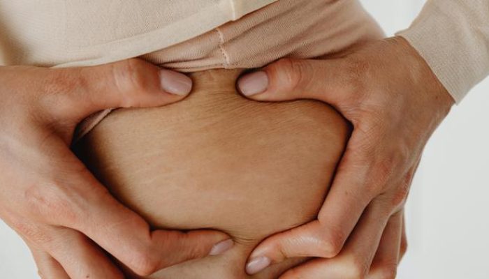Pria Juga Dapat Mengalami Stretch Mark: Fakta, Penyebab, dan Cara Mencegahnya